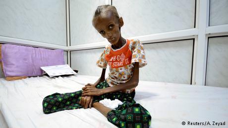 Photo of UN agency reports 2.2 million Yemeni children hungry and in need of care