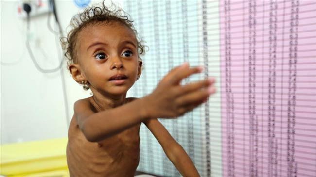 Photo of UN food chief recounts suffering of Yemeni children after trip