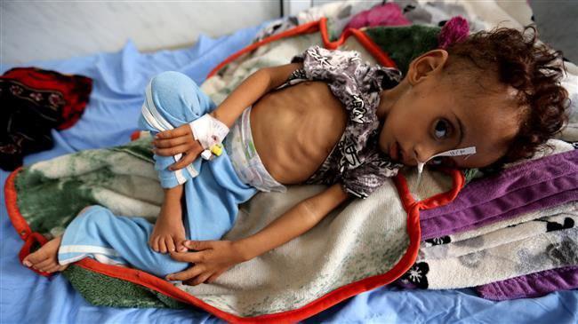 Photo of Almost 85,000 Yemeni kids died from malnutrition amid Saudi war: Save the Children