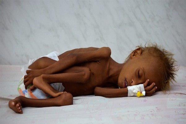 Photo of Over 80,000 Yemeni kids die of starvation in Yemen