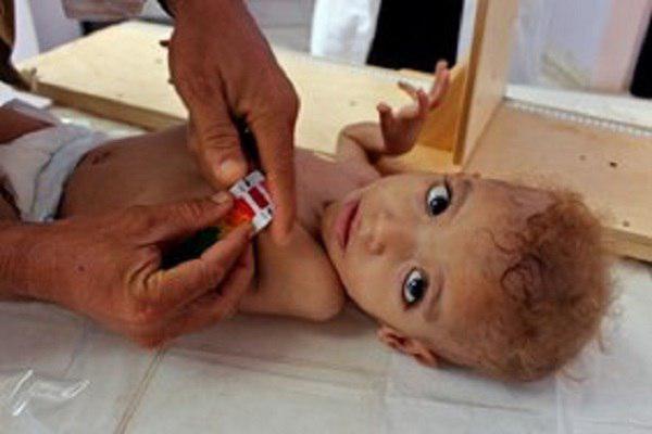 Photo of Yemen’s health minister: 5,400,000 citizens suffer from malnutrition