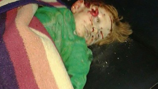 تصویر شهادت دو کودک سوری، در حمله موشکی تروریست ها