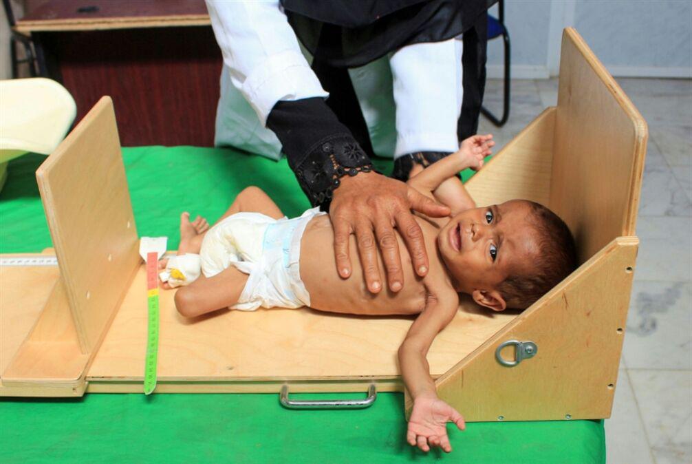 تصویر ۱۶ میلیون یمنی در گرسنگی
