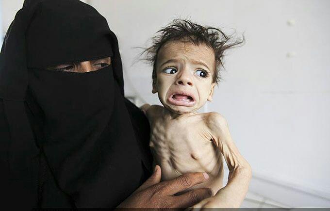 تصویر سوء تغذیه ۵ میلیون و ۴۰۰ هزار کودک یمنی، نتیجه حملات ائتلاف عربی به این کشور