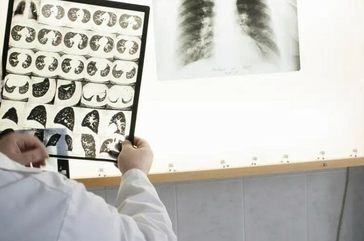 روز جهانی سِل؛ سال گذشته 80 هزار مورد ابتلا به بیماری سِل در افغانستان ثبت شد