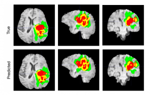 محققان از هوش مصنوعی برای طبقه بندی تومورهای مغزی استفاده می‌کنند