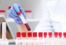 Alzheimer'ın İlerlemesini Tespit Etmek ve Değerlendirmek İçin Yeni Kan Testi